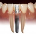 /album/fotogaleria-implantologia/implant1-jpg/